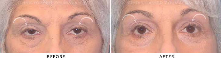 Ptosis Surgery Before & After Photo -  - Patient 4