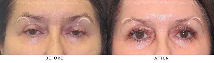 Ptosis Surgery Before & After Photo -  - Patient 5