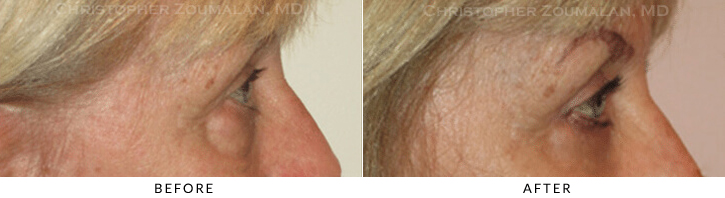 Ptosis Surgery Before & After Photo - Patient Seeing Side - Patient 33C