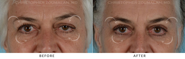 Ptosis Surgery Before & After Photo - Patient Seeing Straight - Patient 6A