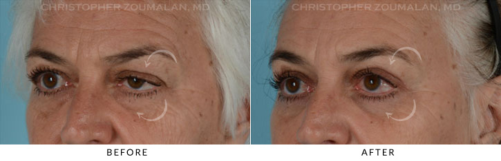 Ptosis Surgery Before & After Photo - Patient Seeing Side - Patient 6C