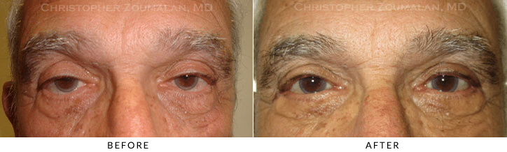 Ptosis Surgery Before & After Photo -  - Patient 73