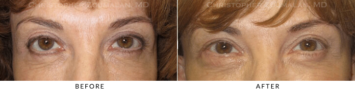 Ptosis Surgery Before & After Photo -  - Patient 74