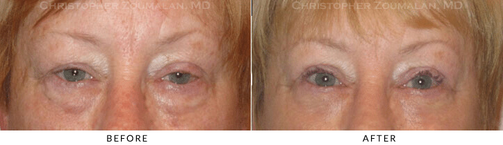 Ptosis Surgery Before & After Photo -  - Patient 75