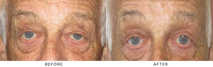 Ptosis Surgery Before & After Photo -  - Patient 76