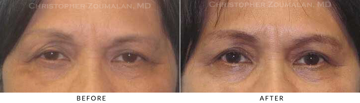 Ptosis Surgery Before & After Photo -  - Patient 10