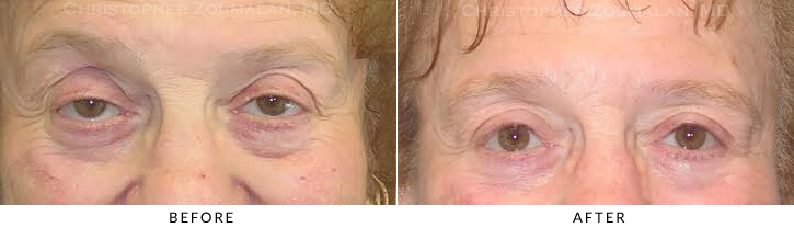 Ptosis Surgery Before & After Photo -  - Patient 11