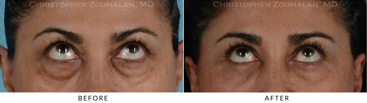 Quad Blepharoplasty Before & After Photo - Patient Seeing Up - Patient 20B