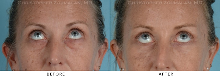 Quad Blepharoplasty Before & After Photo - Patient Seeing Up - Patient 21B