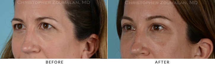 Quad Blepharoplasty Before & After Photo - Patient Seeing Straight - Patient 22B