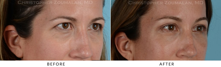 Quad Blepharoplasty Before & After Photo - Patient Seeing Side - Patient 22C