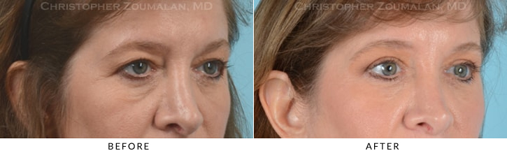 Quad Blepharoplasty Before & After Photo - Patient Seeing Side - Patient 23D