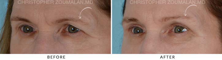 Quad Blepharoplasty Before & After Photo - Patient Seeing Side - Patient 11B