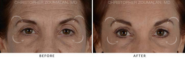 Quad Blepharoplasty Before & After Photo - Patient Seeing Straight - Patient 12A