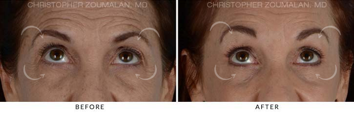 Quad Blepharoplasty Before & After Photo - Patient Seeing Up - Patient 12B