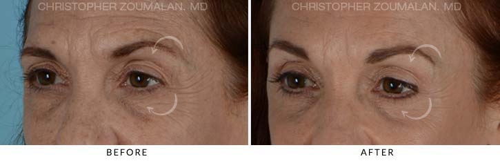 Quad Blepharoplasty Before & After Photo - Patient Seeing Side - Patient 12D