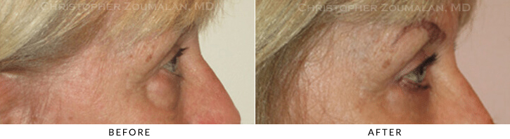 Quad Blepharoplasty Before & After Photo - Patient Seeing Side - Patient 44C