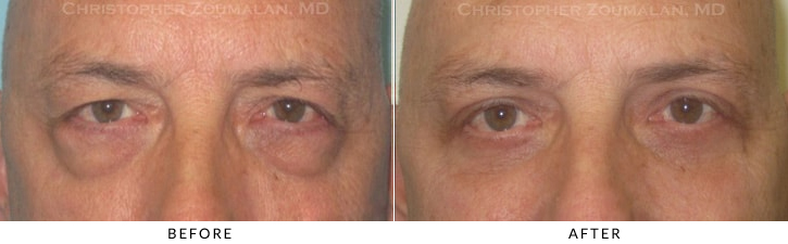 Quad Blepharoplasty Before & After Photo -  - Patient 47