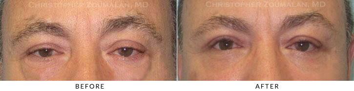 Quad Blepharoplasty Before & After Photo - Patient Seeing Straight - Patient 51A