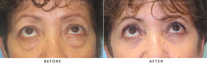 Quad Blepharoplasty Before & After Photo - Patient Seeing Up - Patient 54B