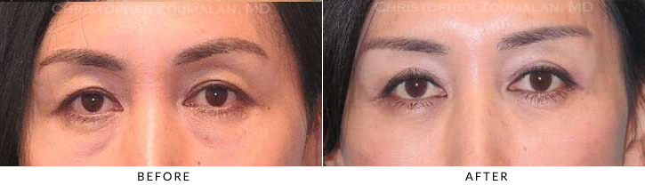 Quad Blepharoplasty Before & After Photo - Patient Seeing Straight - Patient 56A