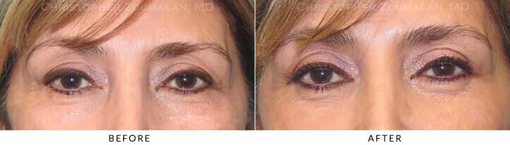 Quad Blepharoplasty Before & After Photo - Patient Seeing Straight - Patient 59A