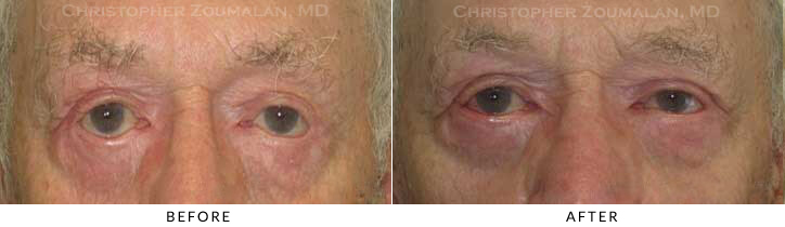 Revisional Eyelid Surgery Before & After Photo -  - Patient 10