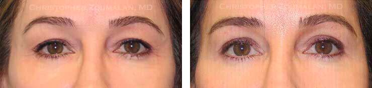 A Natural Looking Blepharoplasty TM technique was used to carefully remove some the patient’s excess skin from her upper lids - female patient before and after picture