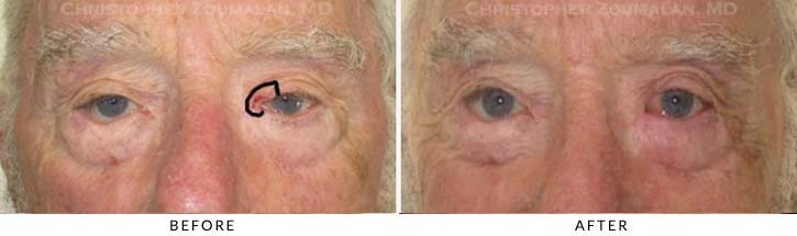 Eyelid Skin Cancer Excision Before & After Photo - Patient Seeing Straight - Patient 11