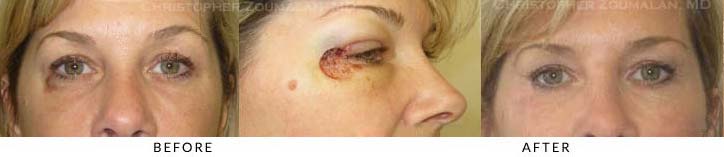 Eyelid Skin Cancer Excision Before & After Photo -  - Patient 12