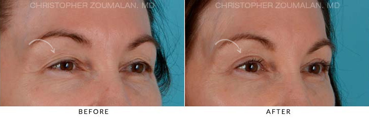 Upper Lid Blepharoplasty Before & After Photo - Patient Seeing side - Patient 17C