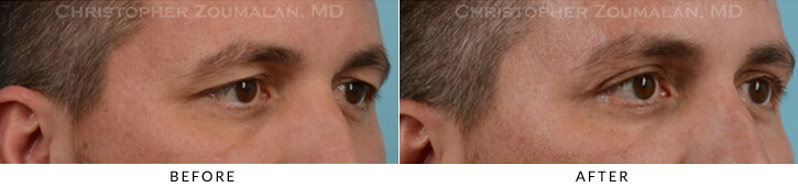 Upper Lid Blepharoplasty Before & After Photo -  - Patient 35A