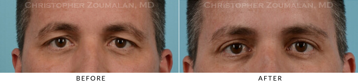 Upper Lid Blepharoplasty Before & After Photo - Patient Seeing Straight - Patient 35C