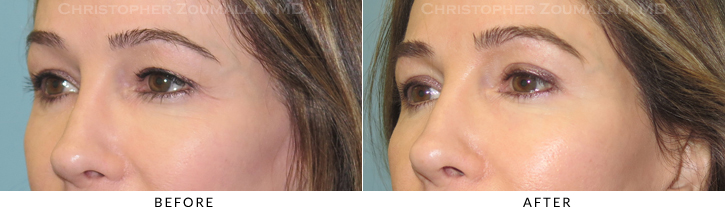 Upper Lid Blepharoplasty Before & After Photo -  - Patient 37B