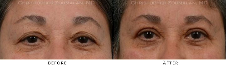 Upper Lid Blepharoplasty Before & After Photo -  - Patient 38