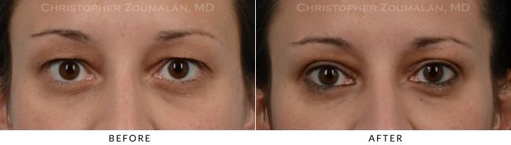 Upper Lid Blepharoplasty Before & After Photo -  - Patient 39