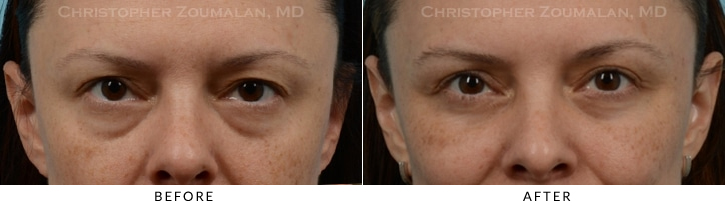 Upper Lid Blepharoplasty Before & After Photo -  - Patient 40B