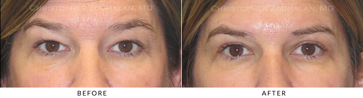 Upper Lid Blepharoplasty Before & After Photo -  - Patient 42