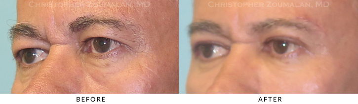 Upper Lid Blepharoplasty Before & After Photo -  - Patient 44C