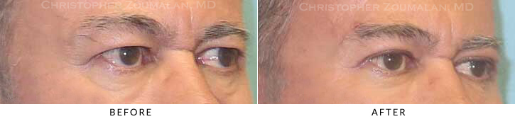 Upper Lid Blepharoplasty Before & After Photo - Patient Seeing Side - Patient 44B