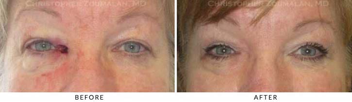 Eyelid Skin Cancer Excision Before & After Photo - Patient Seeing Straight - Patient 2