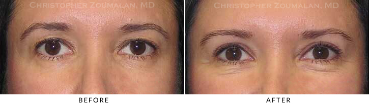 Upper Lid Blepharoplasty Before & After Photo -  - Patient 46