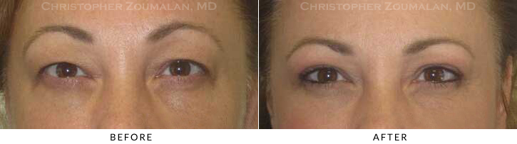 Upper Lid Blepharoplasty Before & After Photo -  - Patient 53