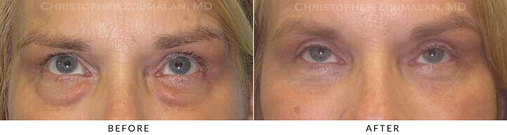 Upper Lid Blepharoplasty Before & After Photo - Patient Seeing Up - Patient 54B