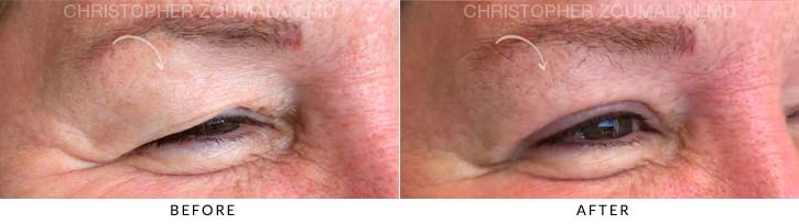 Upper Lid Blepharoplasty Before & After Photo - Patient Seeing Side - Patient 19