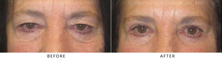 Upper Lid Blepharoplasty Before & After Photo -  - Patient 55