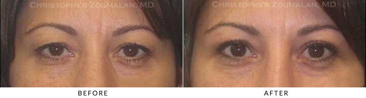 Upper Lid Blepharoplasty Before & After Photo -  - Patient 56