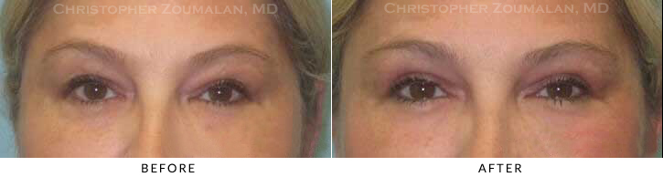 Upper Lid Blepharoplasty Before & After Photo - Patient Seeing Straight - Patient 57A