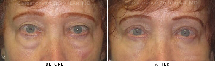 Upper Lid Blepharoplasty Before & After Photo -  - Patient 58