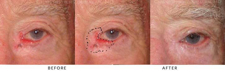 Eyelid Skin Cancer Excision Before & After Photo - Patient Seeing Straight - Patient 4